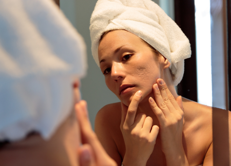 Acne Treatment