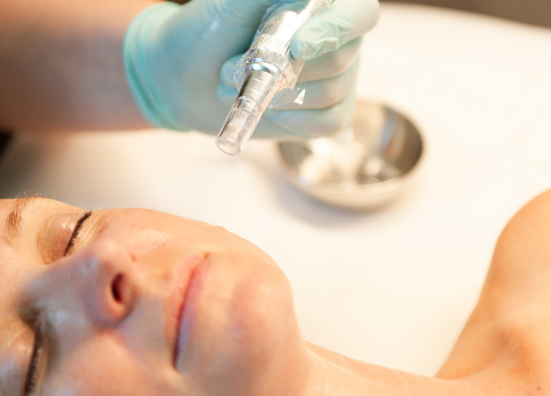 Microneedling